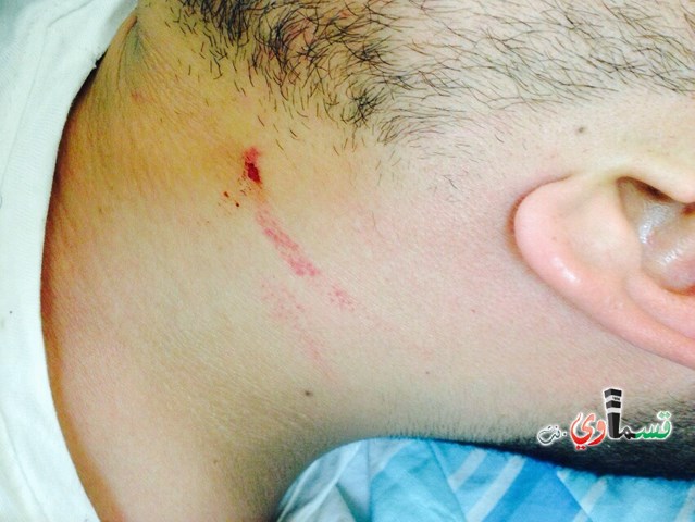 حيفا: قطعان من المتطرفين اليهود يعتدون على الشاب آدم الفقير (25 عاما) من قرية ابطن،